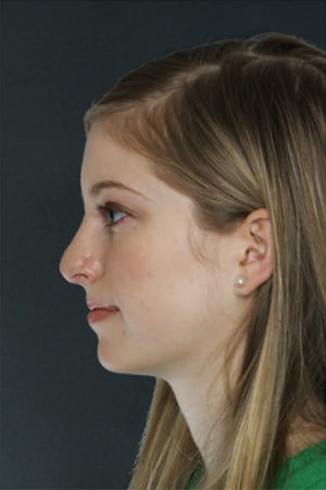 Rhinoplasty Before & After Patient #8996