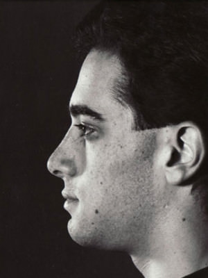 Rhinoplasty Before & After Patient #9001