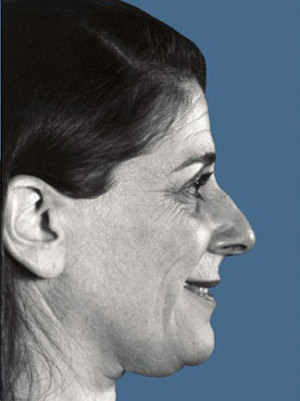 Rhinoplasty Before & After Patient #9006