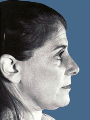 Rhinoplasty Before & After Patient #9006