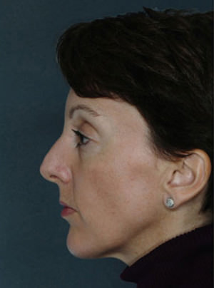 Rhinoplasty Before & After Patient #9011