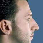 Rhinoplasty Before & After Patient #9016