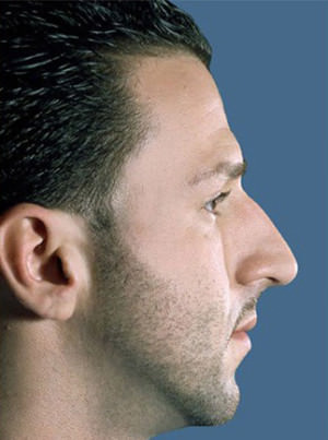 Rhinoplasty Before & After Patient #9016