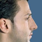 Rhinoplasty Before & After Patient #9016