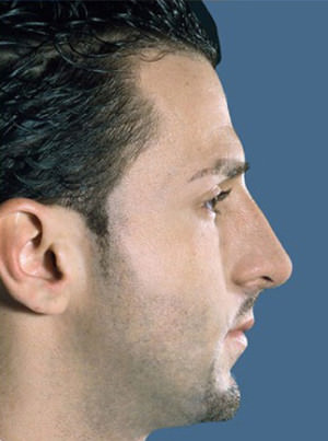 Rhinoplasty Before & After Patient #9016