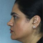 Rhinoplasty Before & After Patient #9019