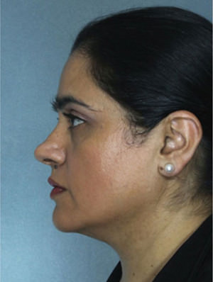 Rhinoplasty Before & After Patient #9019