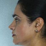 Rhinoplasty Before & After Patient #9019