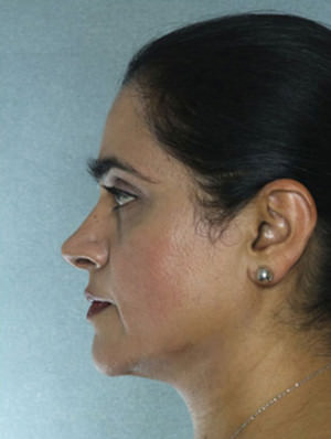 Rhinoplasty Before & After Patient #9019