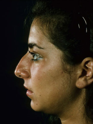 Rhinoplasty Before & After Patient #9024