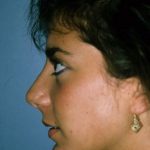 Rhinoplasty Before & After Patient #9024