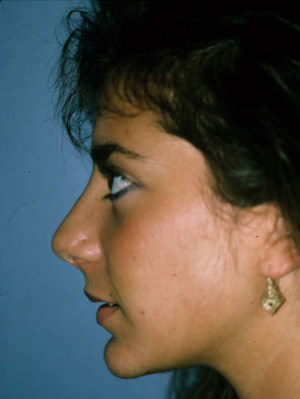Rhinoplasty Before & After Patient #9024
