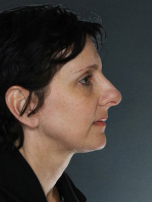 Rhinoplasty Before & After Patient #9027