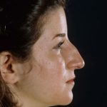 Rhinoplasty Before & After Patient #9047