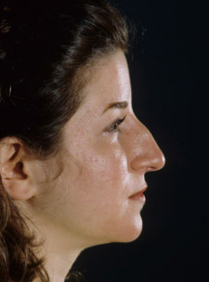 Rhinoplasty Before & After Patient #9047