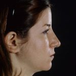 Rhinoplasty Before & After Patient #9047