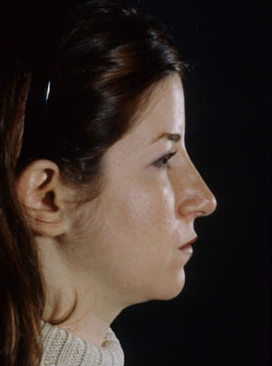 Rhinoplasty Before & After Patient #9047