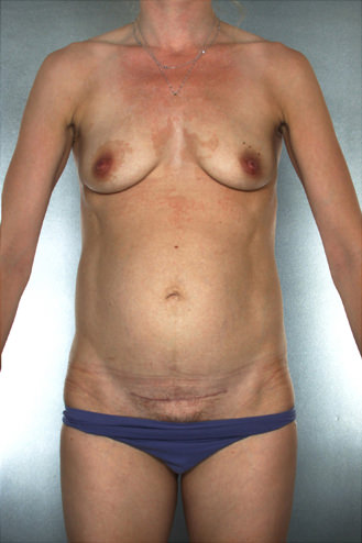 Tummy Tuck Before & After Patient #7965