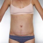 Tummy Tuck Before & After Patient #7965