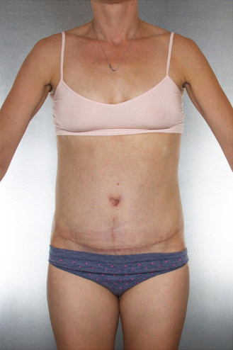 Tummy Tuck Before & After Patient #7965