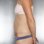 Tummy Tuck Before & After Patient #7965