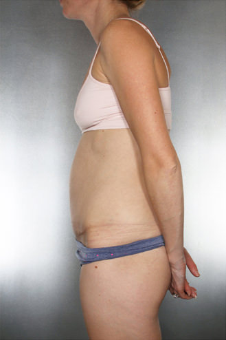 Tummy Tuck Before & After Patient #7965