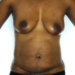 Tummy Tuck Before & After Patient #7950