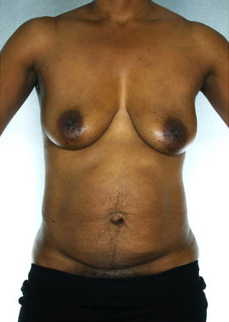 Tummy Tuck Before & After Patient #7950