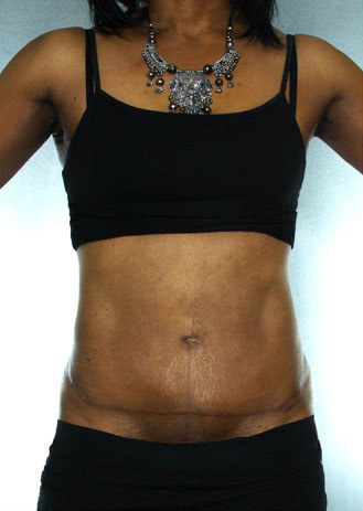 Tummy Tuck Before & After Patient #7950