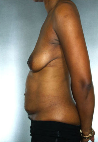 Tummy Tuck Before & After Patient #7950