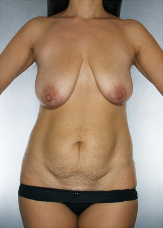 Tummy Tuck Before & After Patient #7935