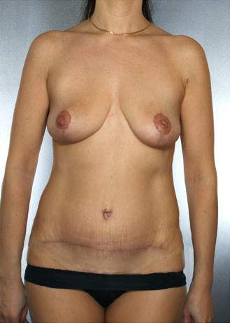 Tummy Tuck Before & After Patient #7935