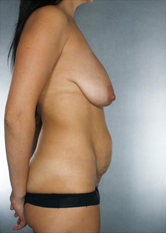 Tummy Tuck Before & After Patient #7935