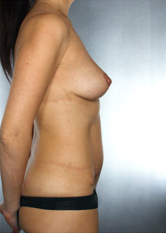 Tummy Tuck Before & After Patient #7935