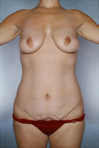 Tummy Tuck Before & After Patient #7930