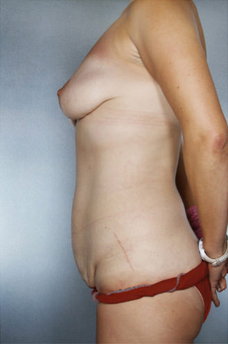 Tummy Tuck Before & After Patient #7930