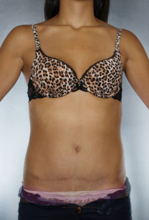 Tummy Tuck Before & After Patient #7973