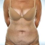 Tummy Tuck Before & After Patient #7978