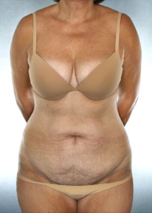 Tummy Tuck Before & After Patient #7978