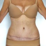 Tummy Tuck Before & After Patient #7978