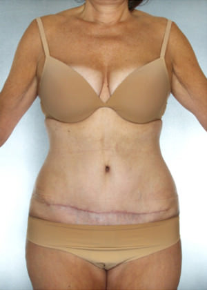 Tummy Tuck Before & After Patient #7978