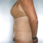 Tummy Tuck Before & After Patient #7978
