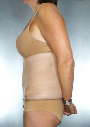 Tummy Tuck Before & After Patient #7978