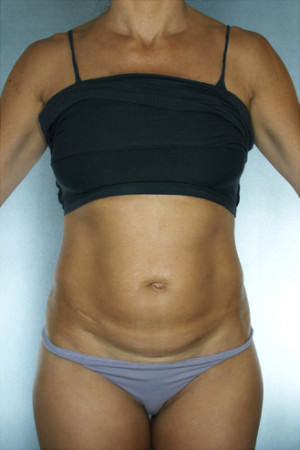 Tummy Tuck Before & After Patient #7983