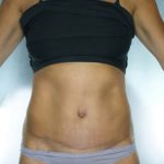 Tummy Tuck Before & After Patient #7983