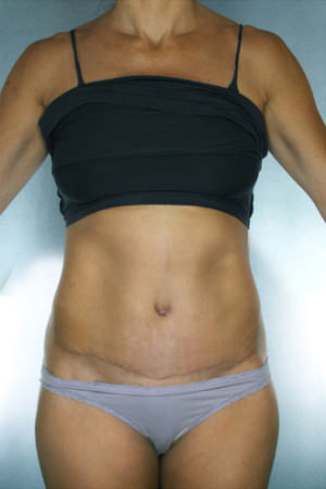 Tummy Tuck Before & After Patient #7983