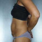 Tummy Tuck Before & After Patient #7983
