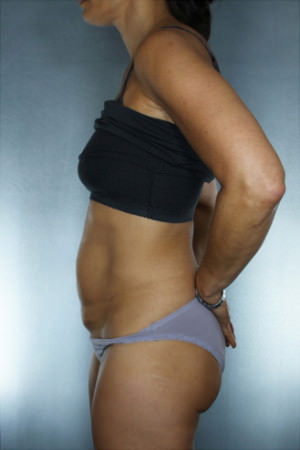 Tummy Tuck Before & After Patient #7983