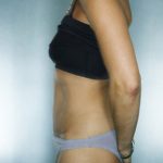 Tummy Tuck Before & After Patient #7983