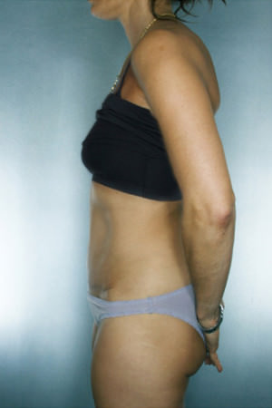 Tummy Tuck Before & After Patient #7983